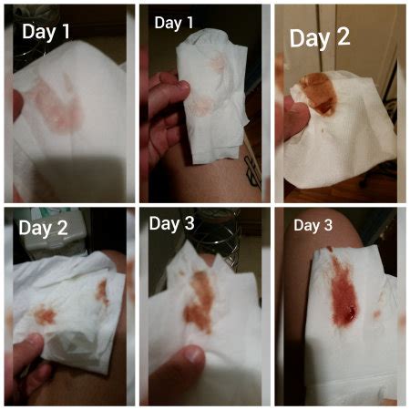 This is normal and not a reason to worry. . When does bleeding start after misoprostol reddit